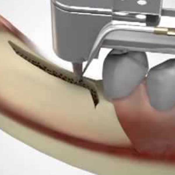 Single tooth implant